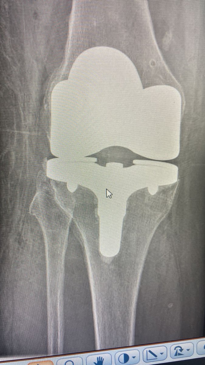 How to Choose the Best Orthopedic Clinics for Joint Replacement in Europe